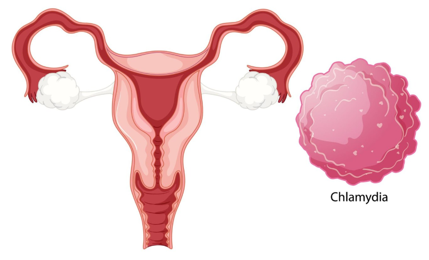 Who Does Chlamydia Affect?