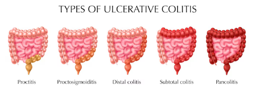 Types of Ulcerative Colitis