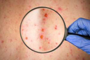 mpox4