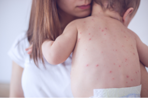 mpox5