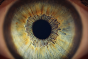 glaucoma1